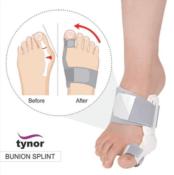 bunion