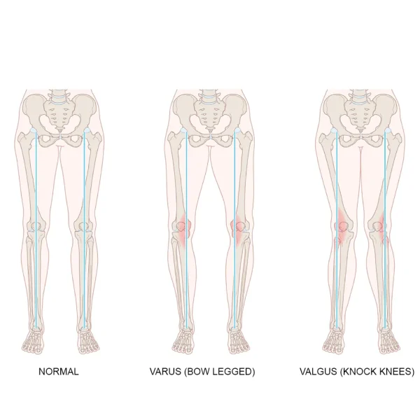 Tynor_OA_Unloader_KneeBrace_Valgus_Varus_Offloading_Knee_Brace_varus_valgus_2048x